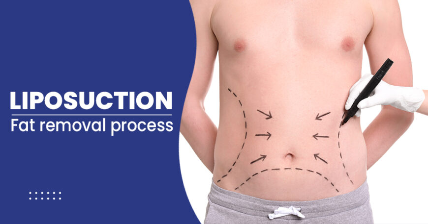Best Liposuction in New Delhi, India