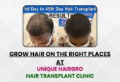 Best hair transplant clinic in tamilnadu