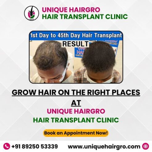 Best hair transplant clinic in tamilnadu