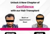 Best hair transplant clinic in tamilnadu