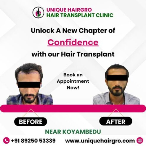 Best hair transplant clinic in tamilnadu