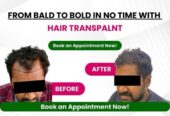 Best hair transplant clinic in tamilnadu