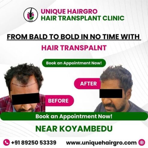 Best hair transplant clinic in tamilnadu